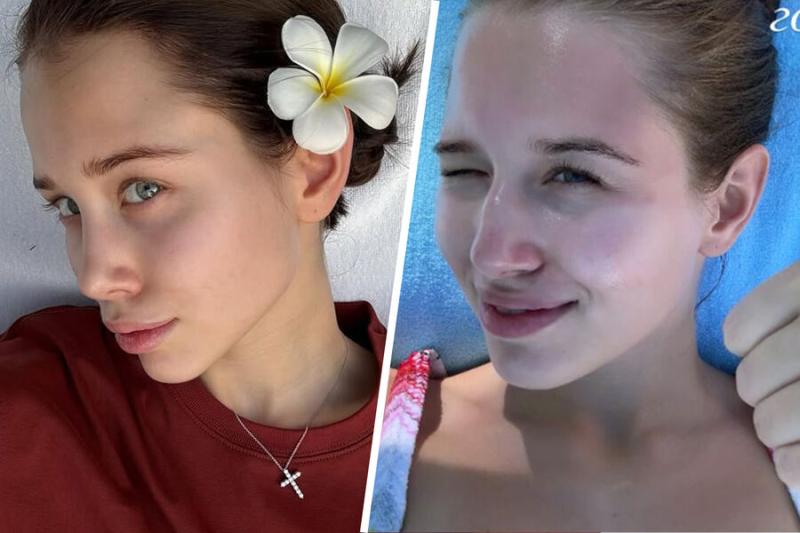 Невеста певца Лепса Аврора выложила фото лица до ринопластики
