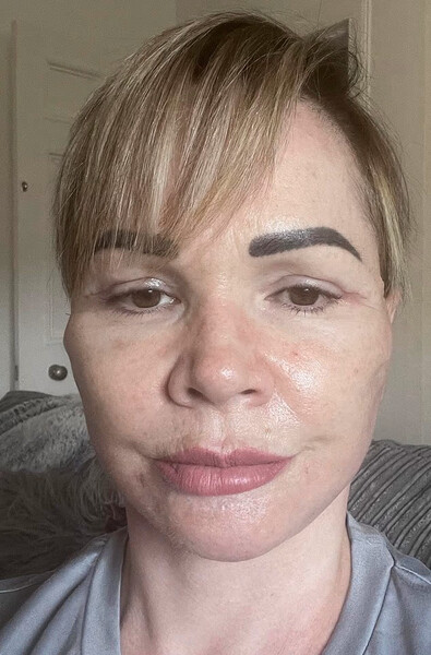 Шотландка осталась с кривым ртом и шрамами после подтяжки лица в Литве