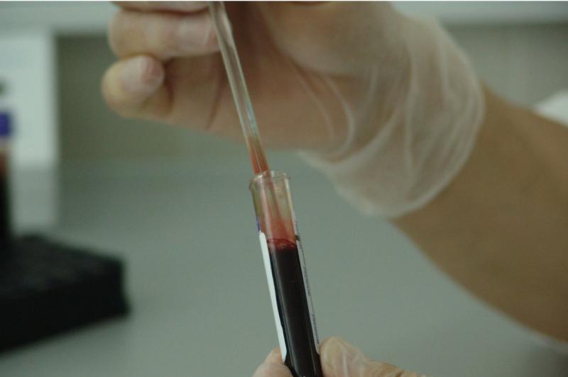 Врач-гепатолог Южнова назвала симптомы жировой болезни печени, ведущие к циррозу