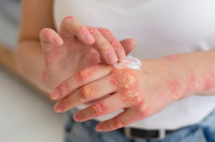 Британский врач рассказал о новом случае каплевидного псориаза у пожилой пациентки