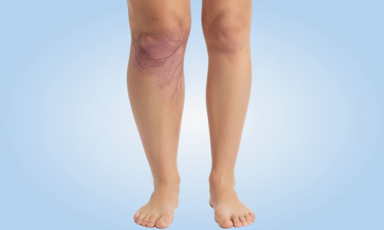 Венозная недостаточность: признаки могут возникать у молодых людей